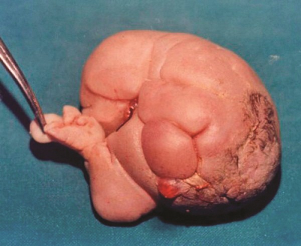 Hiện tượng thai trong thai dưới góc nhìn của y học hiện đại