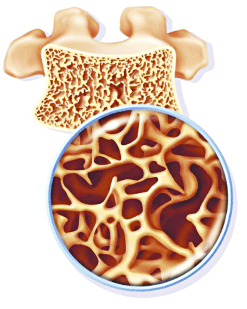 Người trẻ cũng bị loãng xương và chứng đau lưng