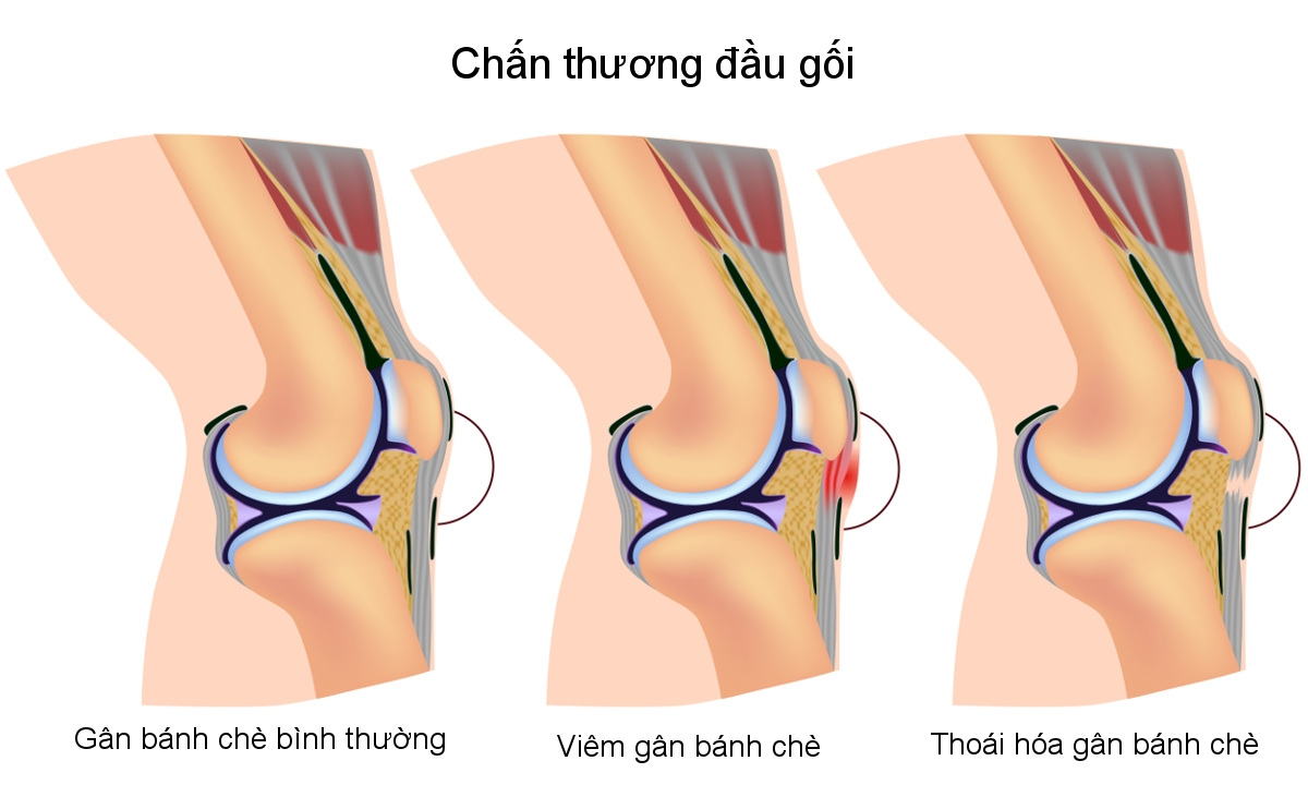 Các dấu hiệu nhận biết bệnh viêm gân