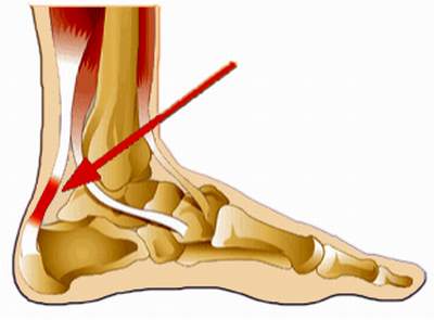 Các dấu hiệu nhận biết bệnh viêm gân