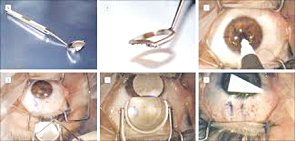 Phẫu thuật Lasik  vài sự thật ít được  nhắc đến