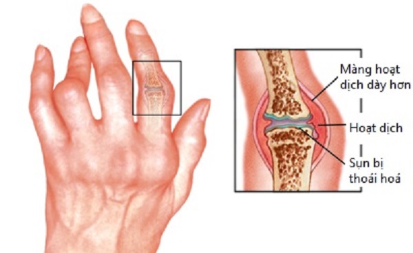 Bài thuốc trị sưng đau các khớp