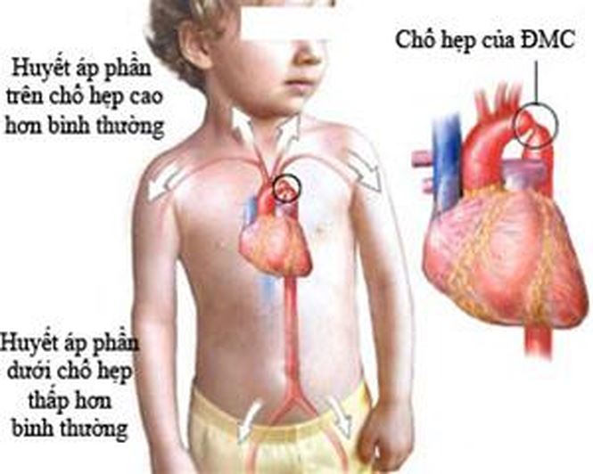 Nhận biết sớm một số bệnh tim bẩm sinh