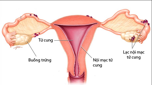 3 nguyên nhân phụ nữ dễ bị hiếm muộn