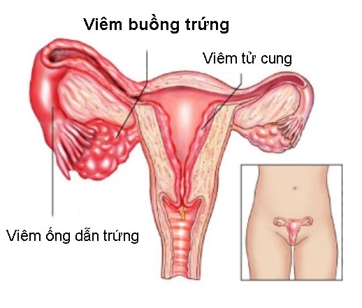 3 nguyên nhân phụ nữ dễ bị hiếm muộn