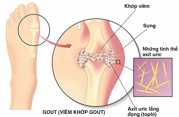 Bệnh gút