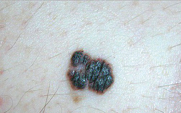 Tia cực tím và nguy cơ gây ra ung thư da