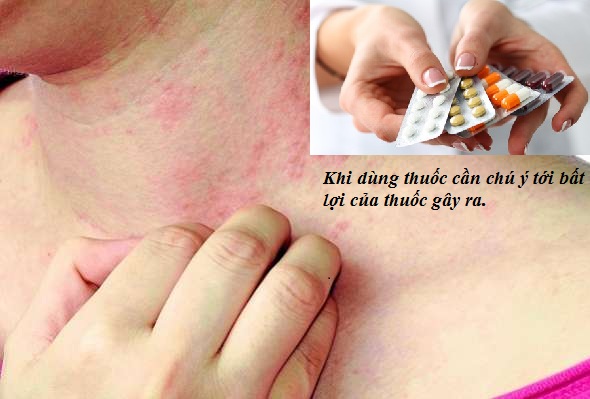 Các thuốc trị dị ứng: Nhận diện những bất lợi khi sử dụng