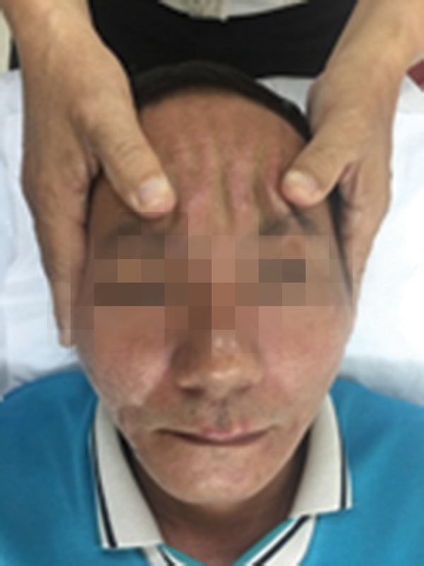 Điều trị liệt VII ngoại biên hai bên mặt bằng phương pháp không dùng thuốc y học cổ truyền