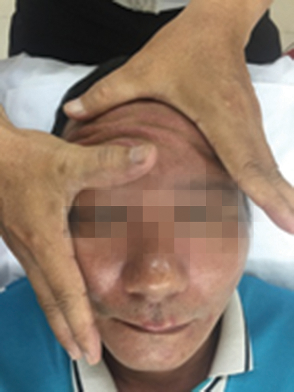 Điều trị liệt VII ngoại biên hai bên mặt bằng phương pháp không dùng thuốc y học cổ truyền