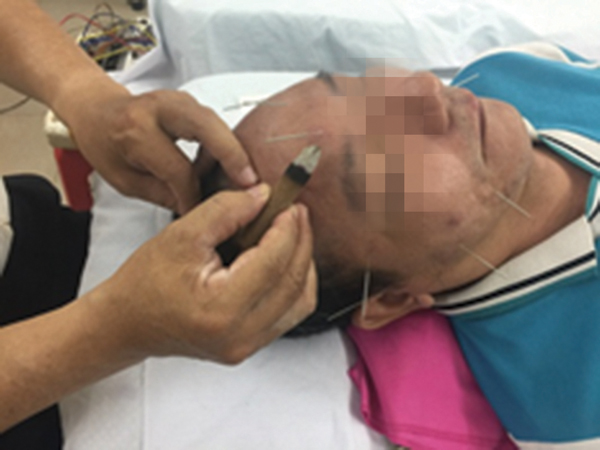 Điều trị liệt VII ngoại biên hai bên mặt bằng phương pháp không dùng thuốc y học cổ truyền