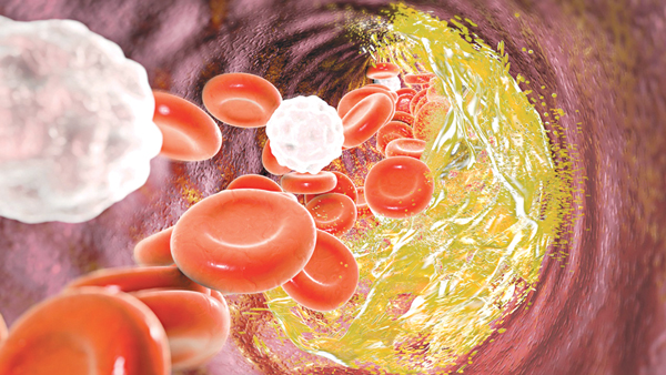 Vai trò của dinh dưỡng trong rối loạn chuyển hóa lipid máu