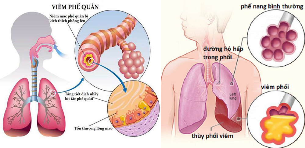 Chứng phong ôn và thuốc trị