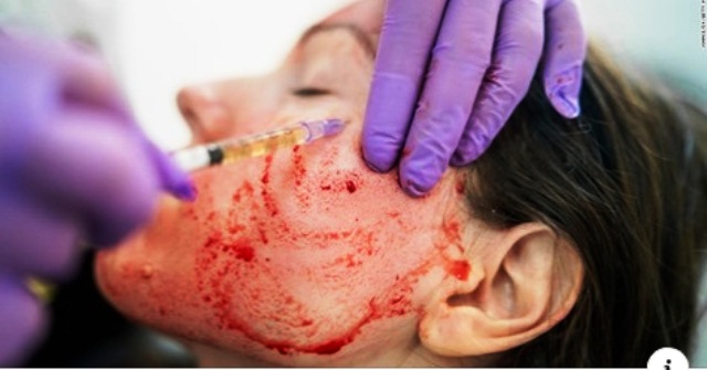 Coi chừng mắc bệnh trọng từ lăn kim máu để trẻ hóa da