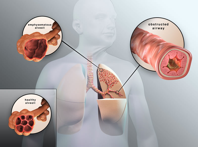 Bệnh phổi tắc nghẽn mạn tính (COPD)