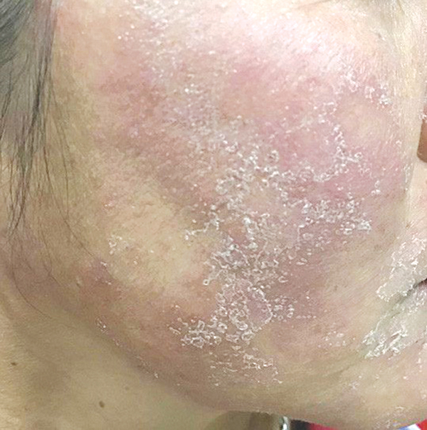 Tự hủy hoại làn da bằng kem làm đẹp thần tốc