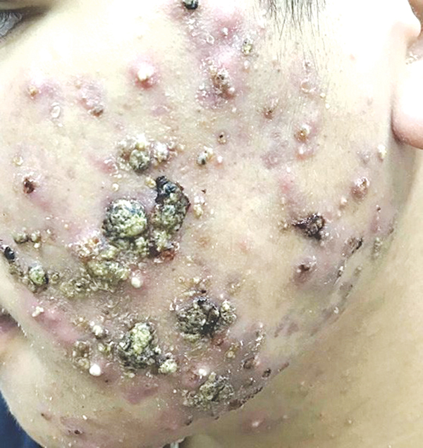 Tự hủy hoại làn da bằng kem làm đẹp thần tốc