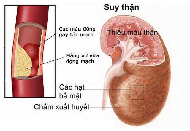 Cách ngừa xơ vữa động mạch