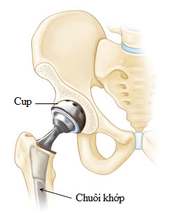 Coi chừng gãy xương sau thay khớp háng