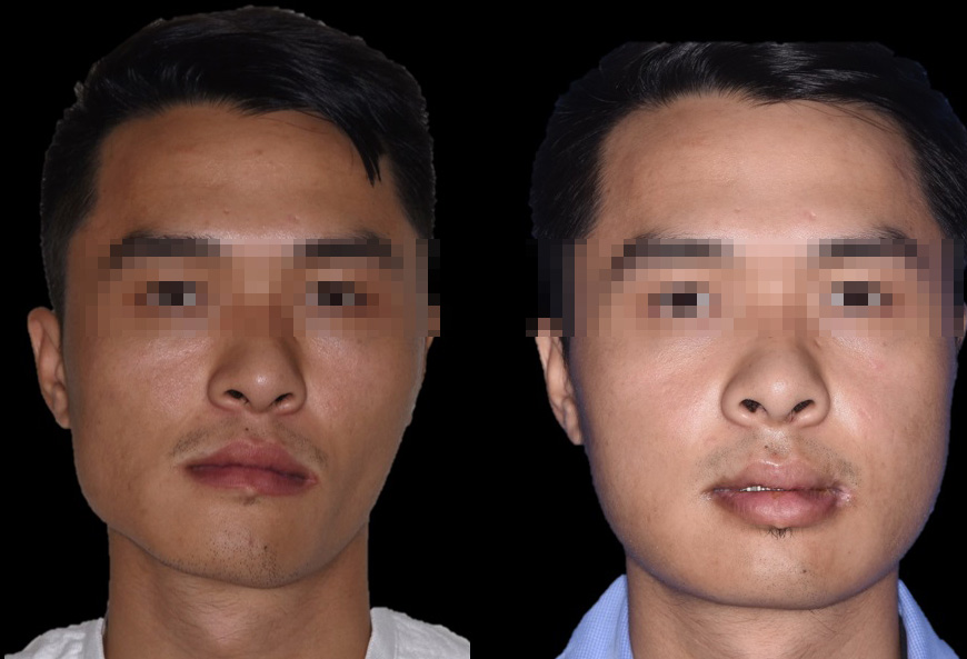 Nội soi kết hợp chỉnh hình phẫu thuật thành công khối u lồi cầu xương hàm