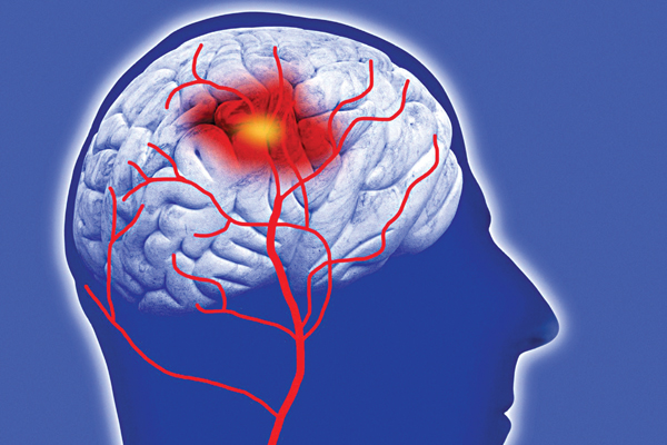 Gia tăng nguy cơ xuất huyết não khi sử dụng aspirin hàng ngày với liều thấp