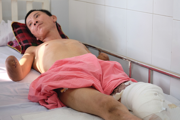 Tàn phế từ những bất cẩn với dòng điện
