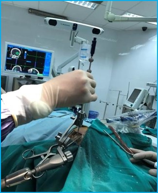 Phẫu thuật không cần mở sọ