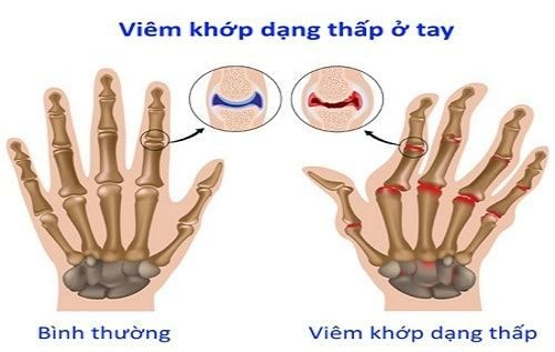 Methotrexate ảnh hưởng đến thai kỳ thế nào?