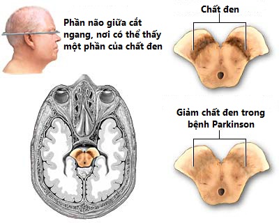 Giảm nhẹ ảnh hưởng của bệnh Parkinson