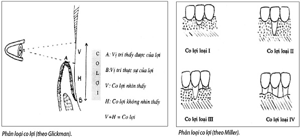 Đừng coi thường hậu quả của co lợi