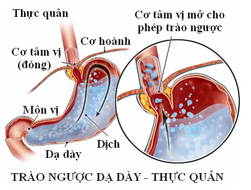 Bài thuốc trị bệnh  trào ngược dạ dày thực quản