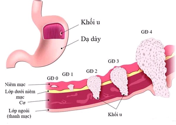 3. Nguyên nhân khiến ung thư khó điều trị