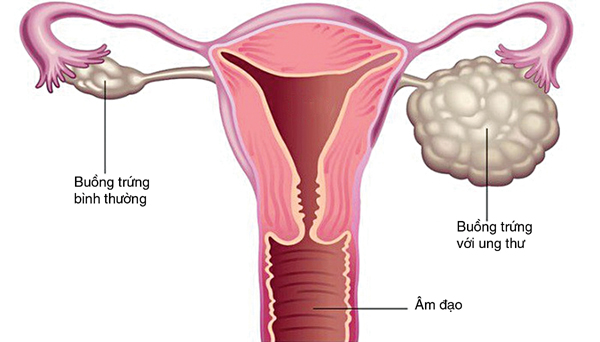 Diễn tiến và triệu chứng của ung thư buồng trứng