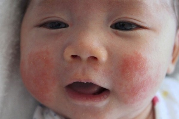 Cách chữa trị một số bệnh viêm da thường gặp ở trẻ em