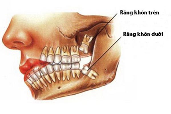 Các biến chứng do răng khôn mọc lệch ngầm