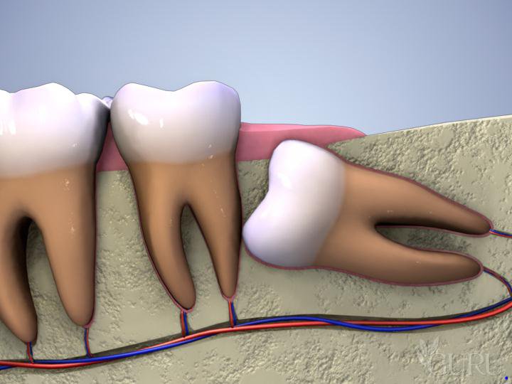 Các biến chứng do răng khôn mọc lệch ngầm