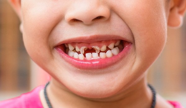 Dự phòng bệnh sâu răng ở trẻ em
