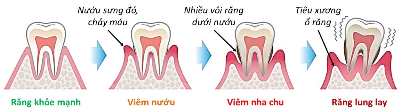 Những nguy hiểm bất ngờ từ  viêm nướu, viêm nha chu