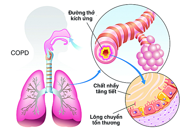 Cần hiểu rõ hơn về bệnh phổi tắc nghẽn mạn tính