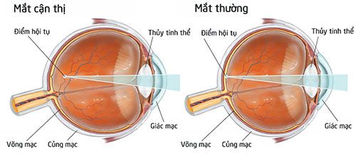 Cận thị học đường