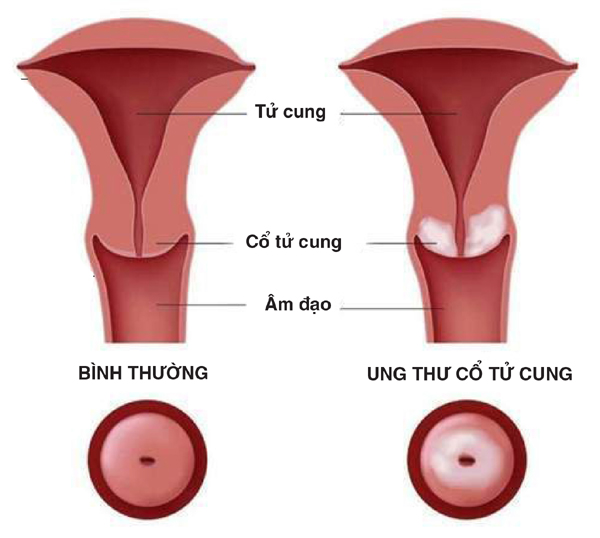 Chất lượng sống sau khi điều trị ung thư cổ tử cung