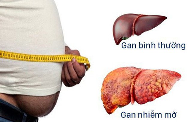 Nguy cơ bệnh gan nhiễm mỡ không do rượu