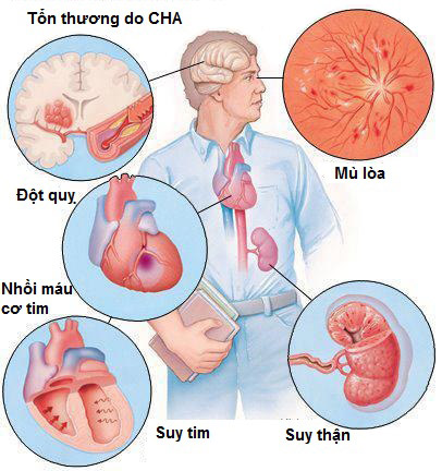 Cảnh giác với biến chứng của tăng huyết áp