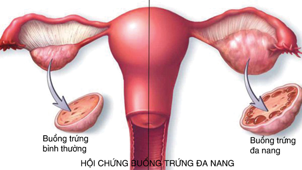 Những bệnh lý cản trở chuyện thụ thai