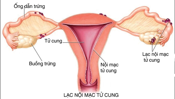 Những bệnh lý cản trở chuyện thụ thai