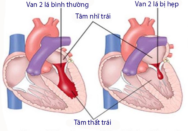 Nguyên nhân nào gây bệnh van tim?