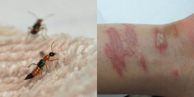 bệnh vảy nến