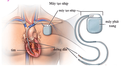 Nhận diện “thủ phạm” gây rối loạn nhịp tim