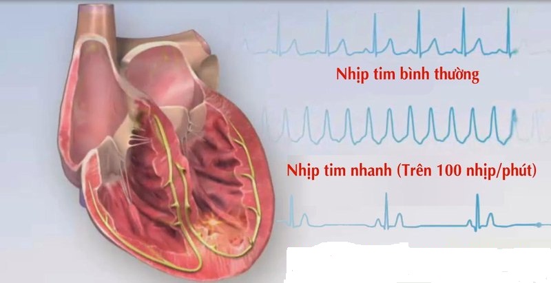 Nhận diện “thủ phạm” gây rối loạn nhịp tim