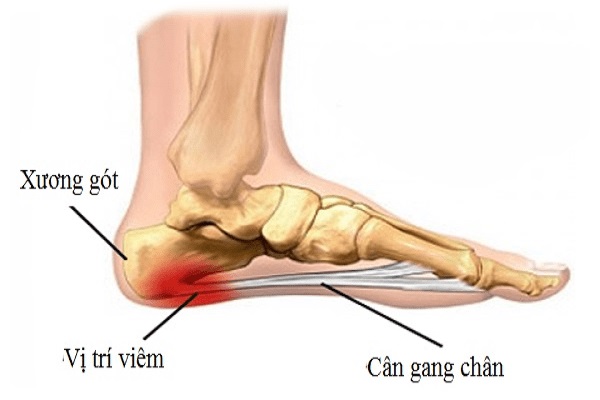 Xử trí viêm cân gan chân không phẫu thuật